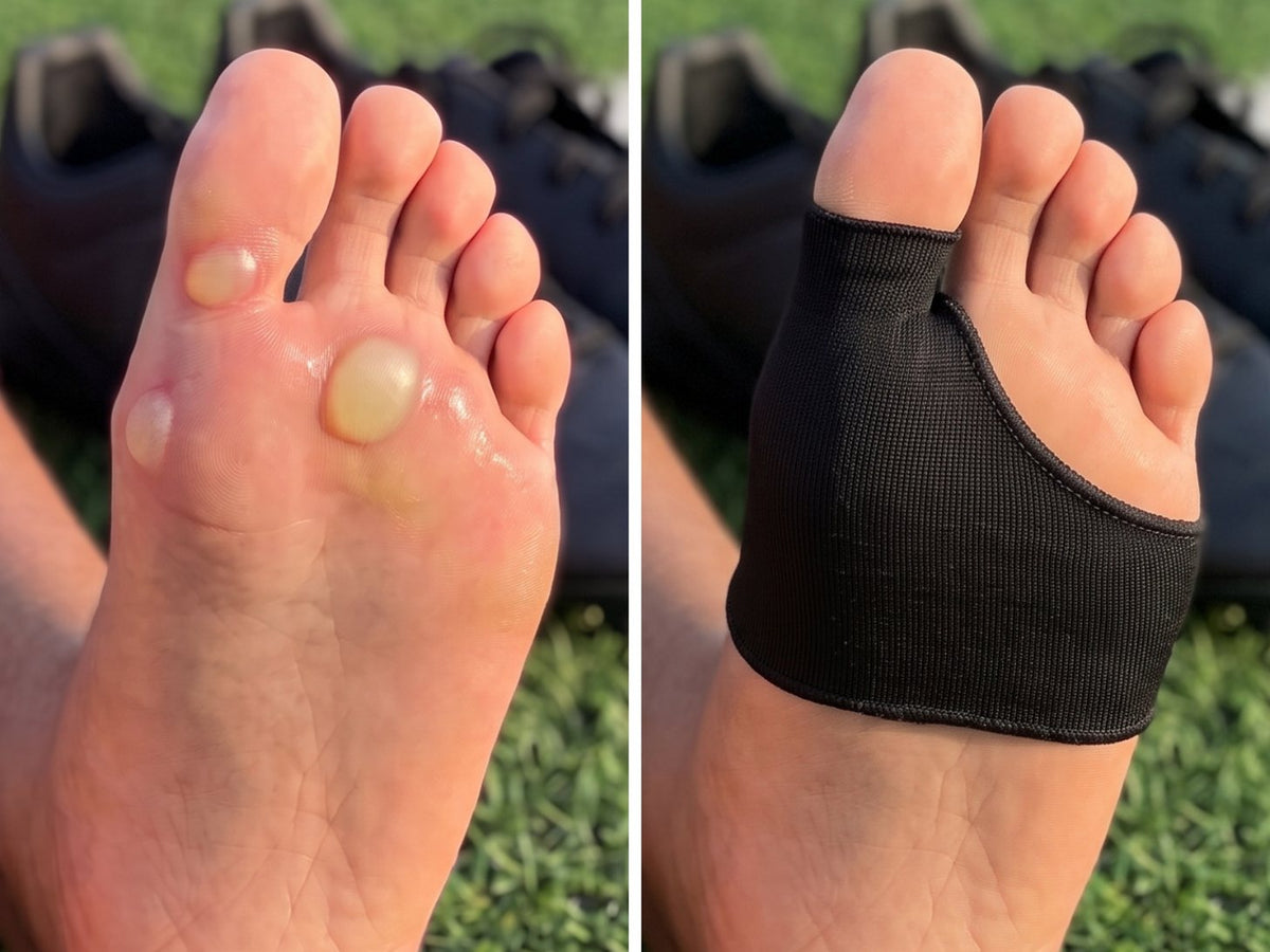 The same foot shown twice: closed blisters on the left, wearing the Olyra Blister Sleeve on the right